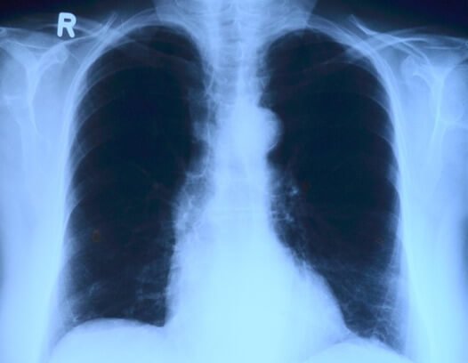 Lungs X-Ray